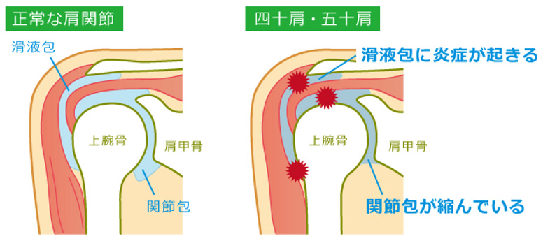 正常な肩関節と、四十肩・五十肩